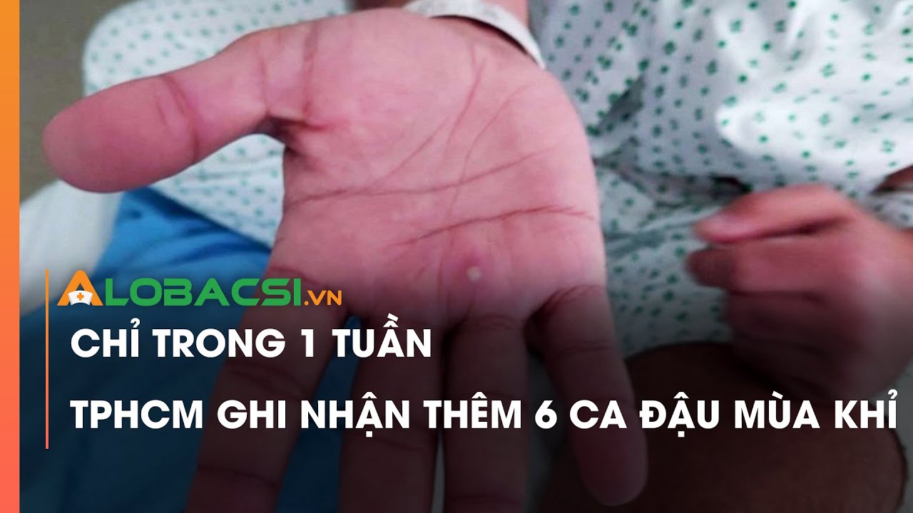 Chỉ trong 1 tuần TP HCM ghi nhận thêm 6 ca đậu mùa khỉ