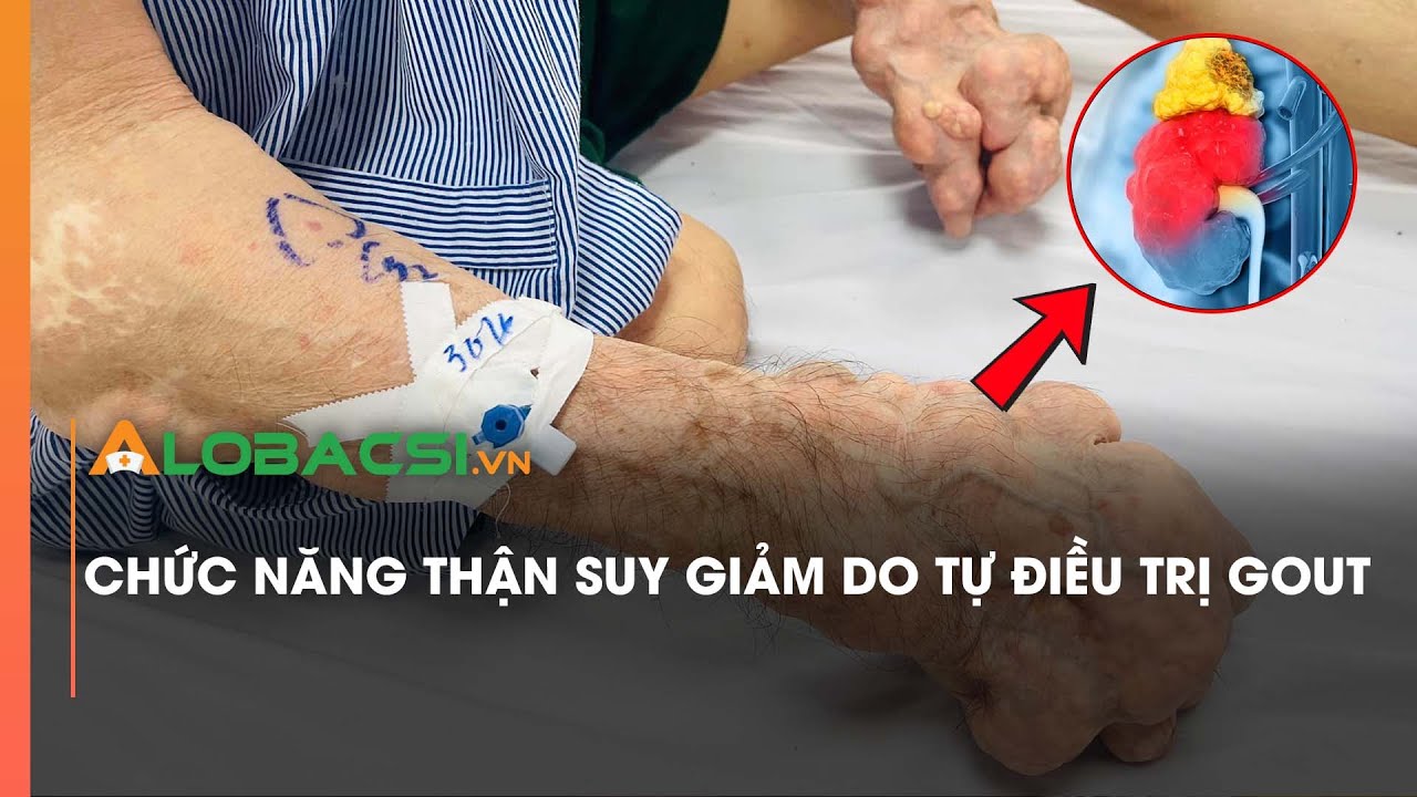 Chức năng thận suy giảm do tự điều trị gout