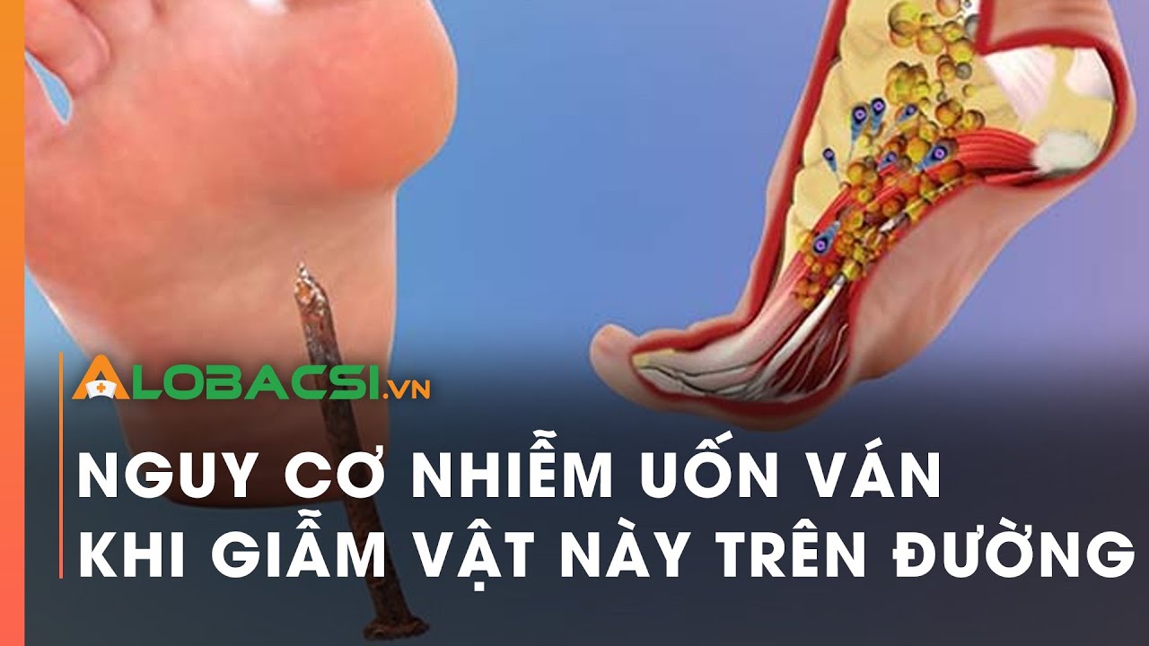 Nguy cơ nhiễm uốn ván khi giẫm vật này trên đường