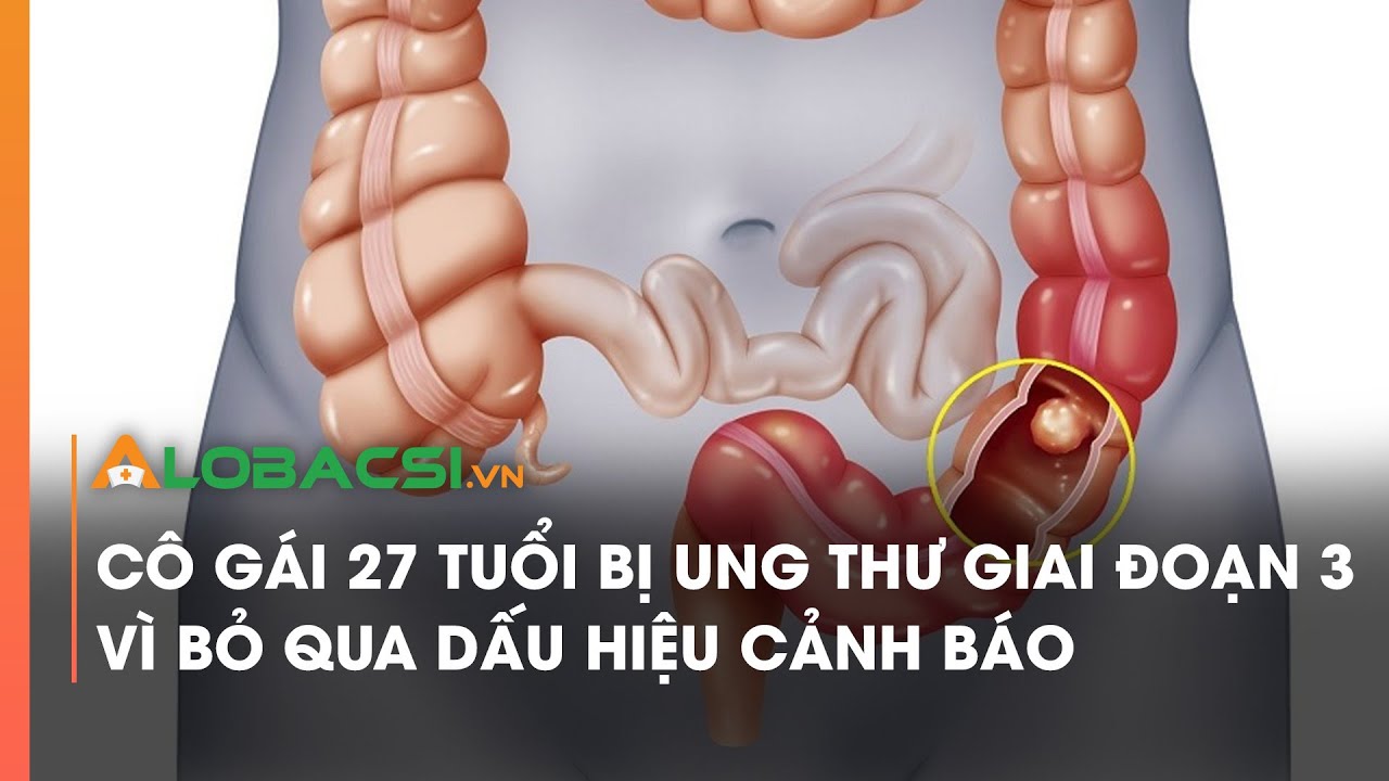 Cô gái 27 tuổi bị ung thư giai đoạn 3 vì bỏ qua dấu hiệu cảnh báo