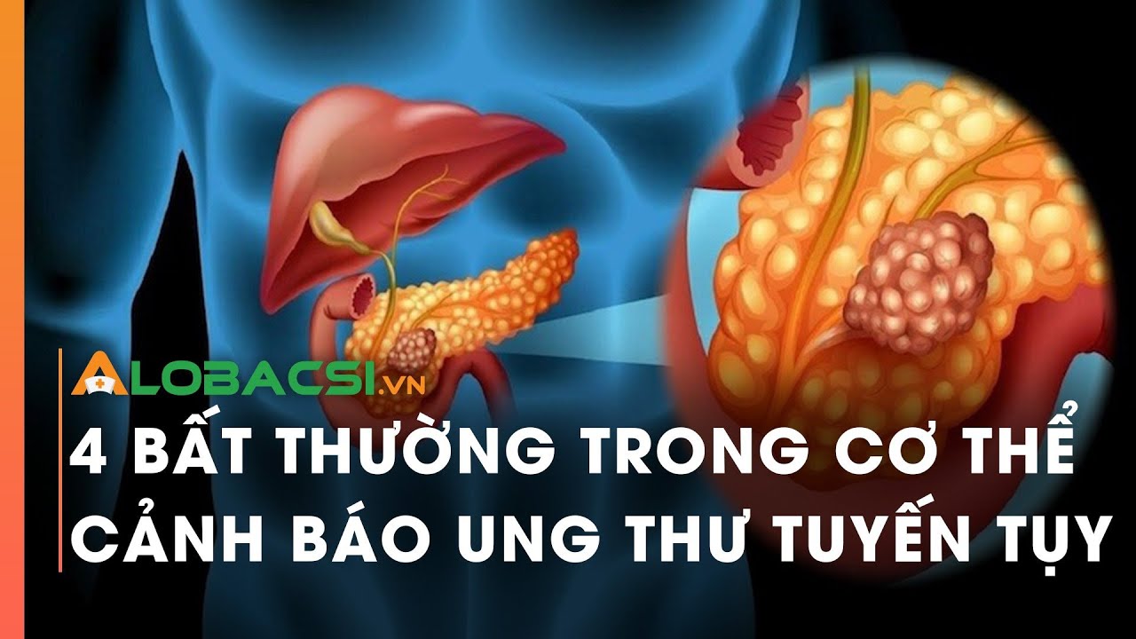 4 bất thường trong cơ thể cảnh báo ung thư tuyến tụy