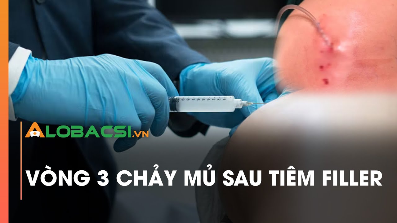 Vòng 3 chảy mủ sau tiêm filler