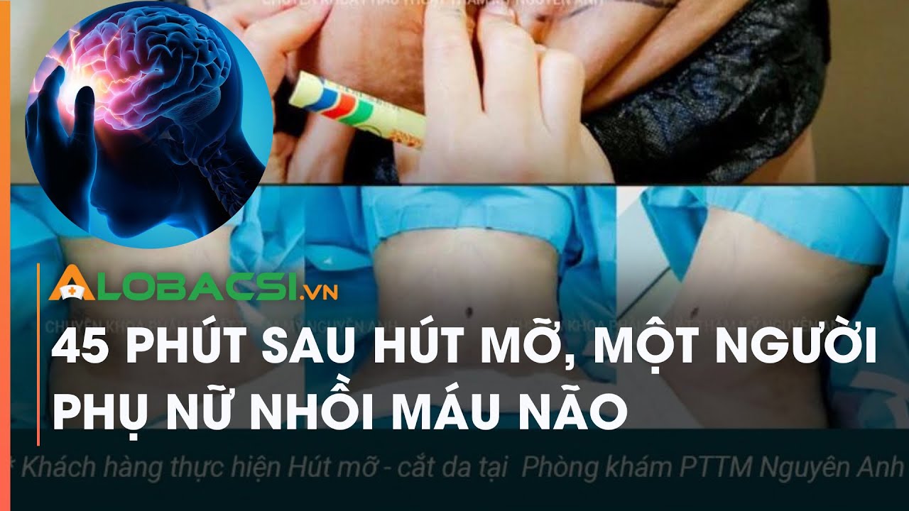 45 phút sau hút mỡ, một người phụ nữ nhồi máu não