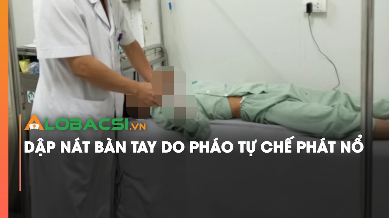 Dập nát bàn tay do pháo tự chế phát nổ