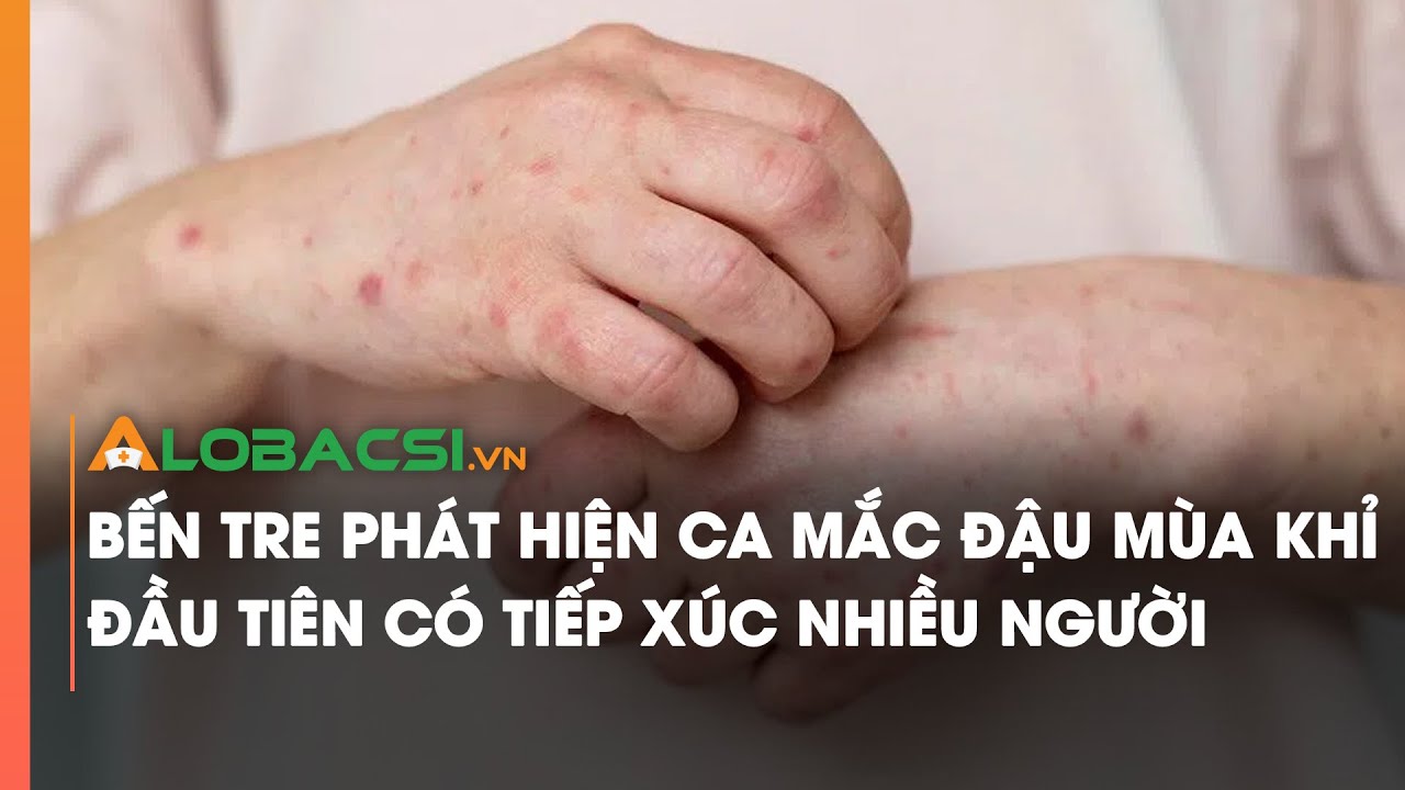 Bến Tre phát hiện ca mắc đậu mùa khỉ đầu tiên có tiếp xúc nhiều người