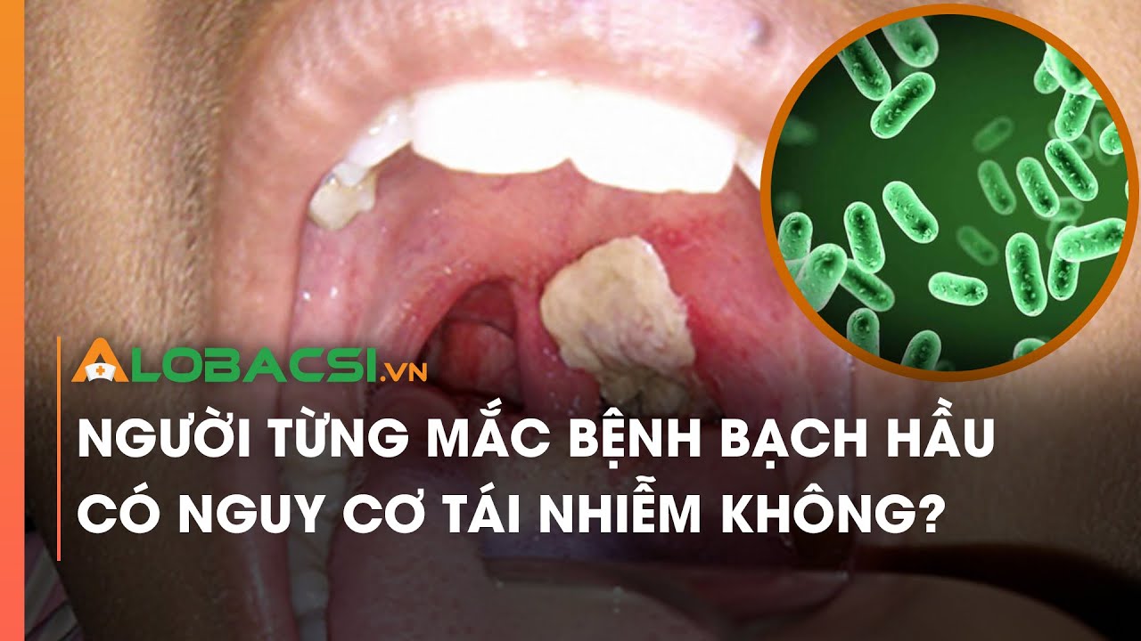 Người từng mắc bệnh bạch hầu có nguy cơ tái nhiễm không?