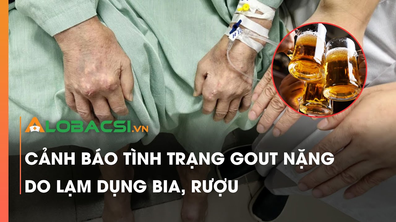 Cảnh báo tình trạng gout nặng do lạm dụng bia, rượu