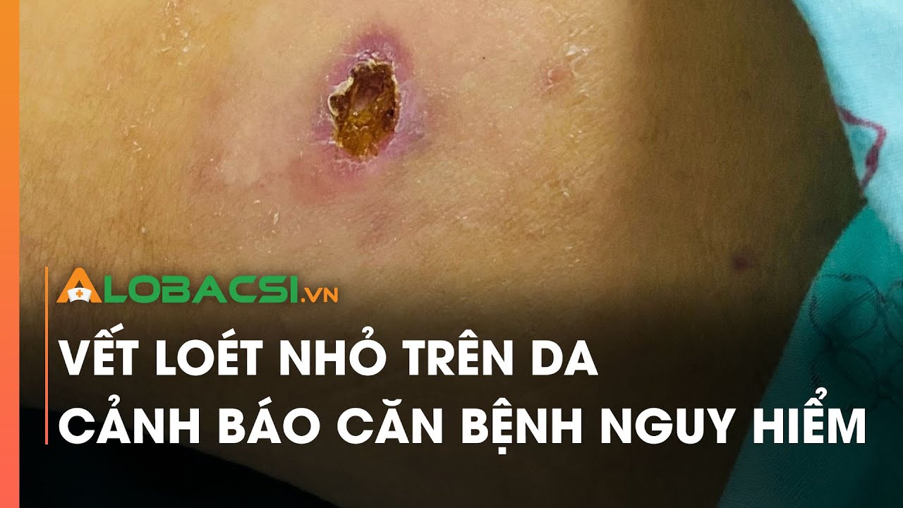 Vết loét nhỏ trên da cảnh báo căn bệnh nguy hiểm