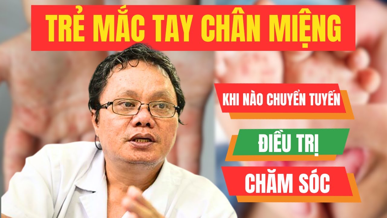 Bệnh tay chân miệng, khi nào cần chuyển tuyến?