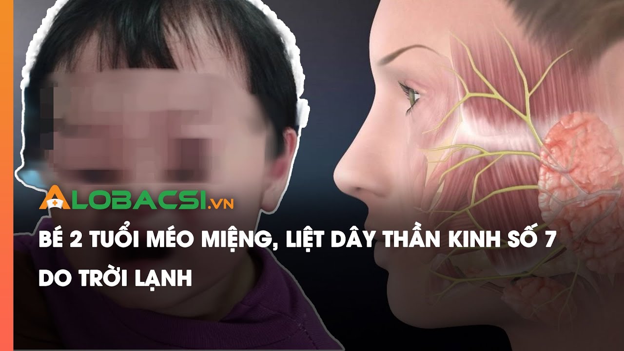 Bé 2 tuổi méo miệng, liệt dây thần kinh số 7 do trời lạnh