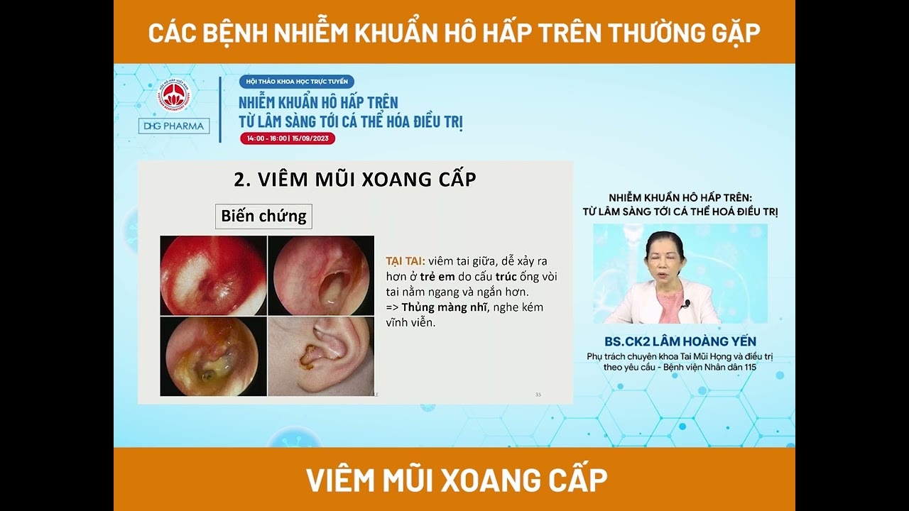 VIÊM MŨI XOANG CẤP: Biến chứng và phác đồ điều trị