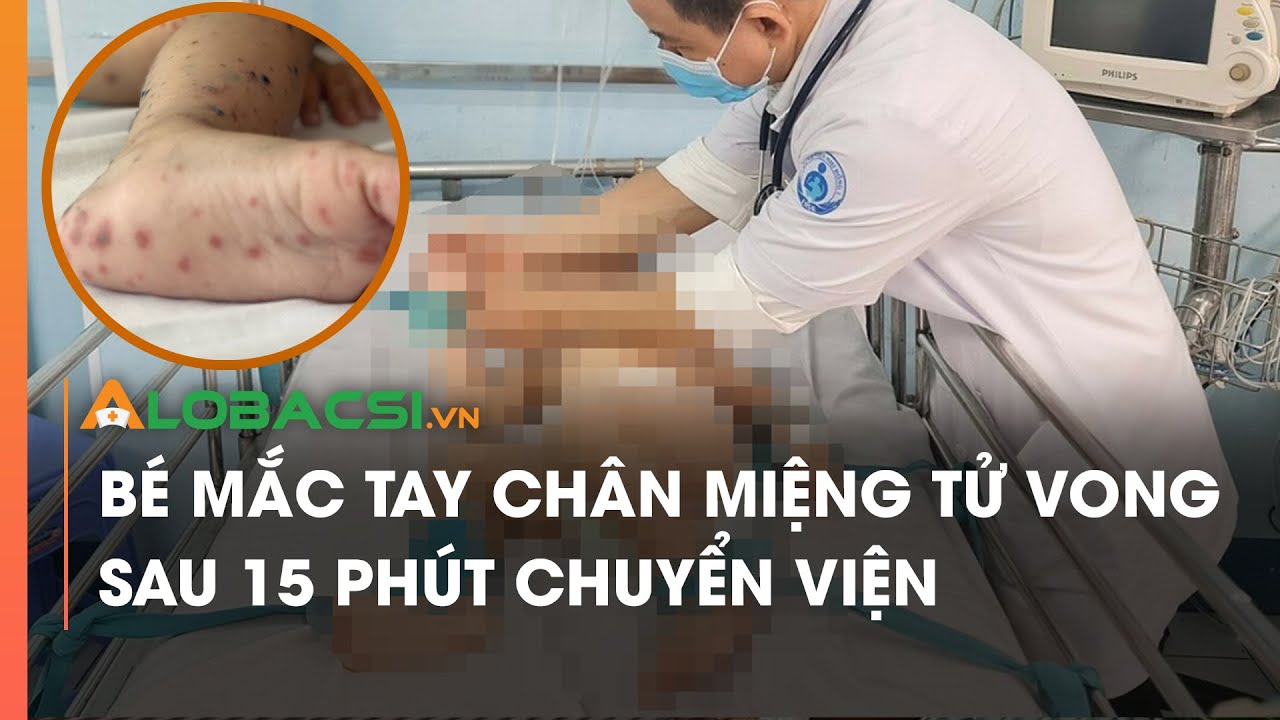 Bé mắc tay chân miệng tử vong sau 15 phút chuyển viện