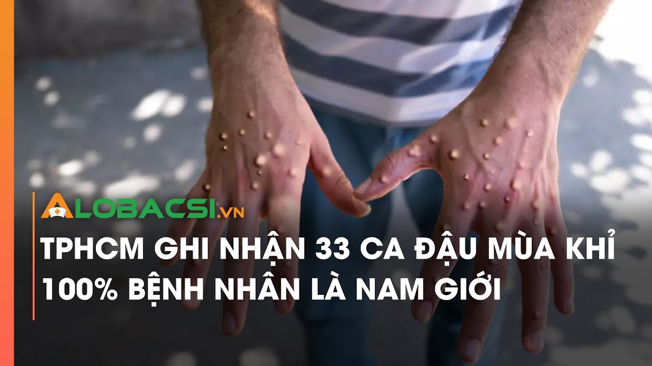 TP HCM ghi nhận 33 ca đậu mùa khỉ, 100% bệnh nhân là nam giới