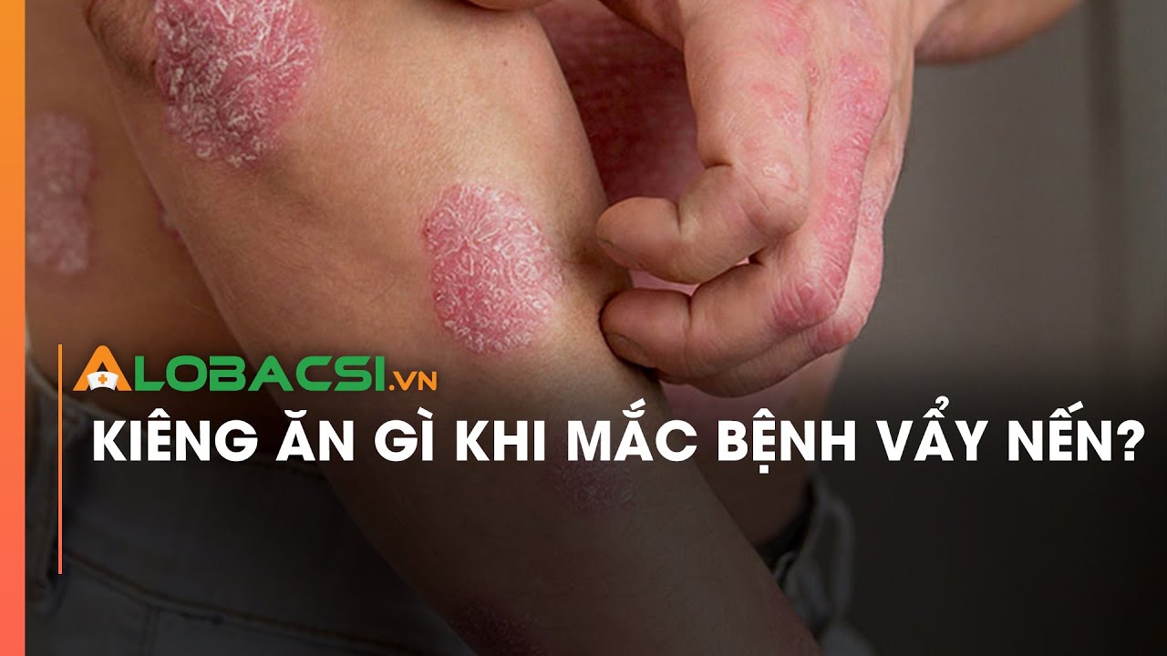 Kiêng ăn gì khi mắc bệnh vẩy nến?