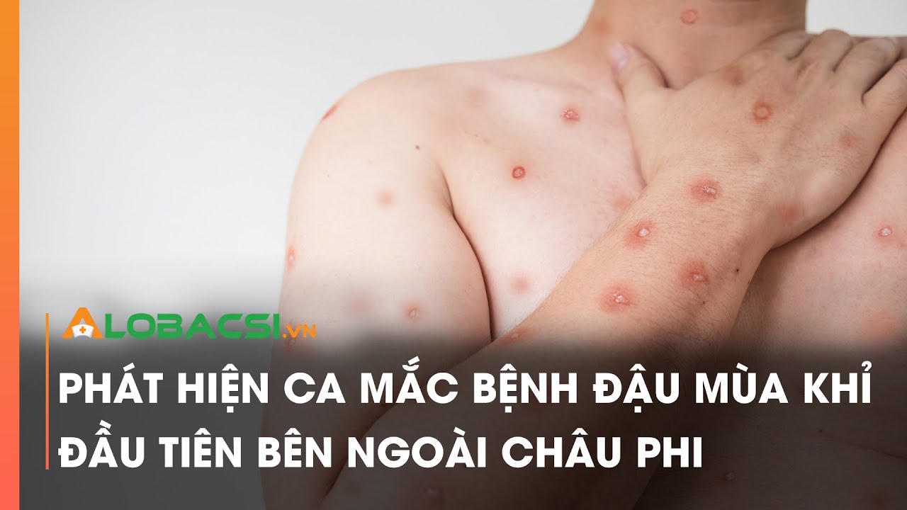 Phát hiện ca mắc bệnh đậu mùa khỉ đầu tiên bên ngoài châu Phi | Video Alobacsi