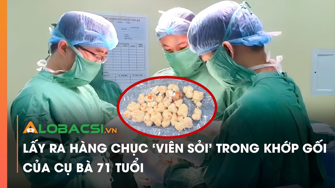 Lấy ra hàng chục 'viên sỏi' trong khớp gối của cụ bà 71 tuổi