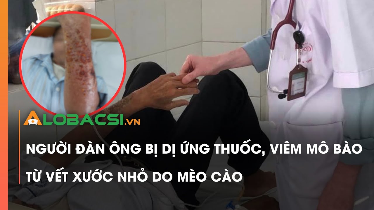 Người đàn ông bị dị ứng thuốc, viêm mô bào từ vết xước nhỏ do mèo cào