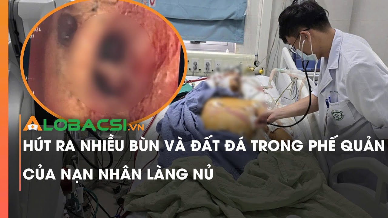 Hút ra nhiều bùn và đất đá trong phế quản của nạn nhân Làng Nủ