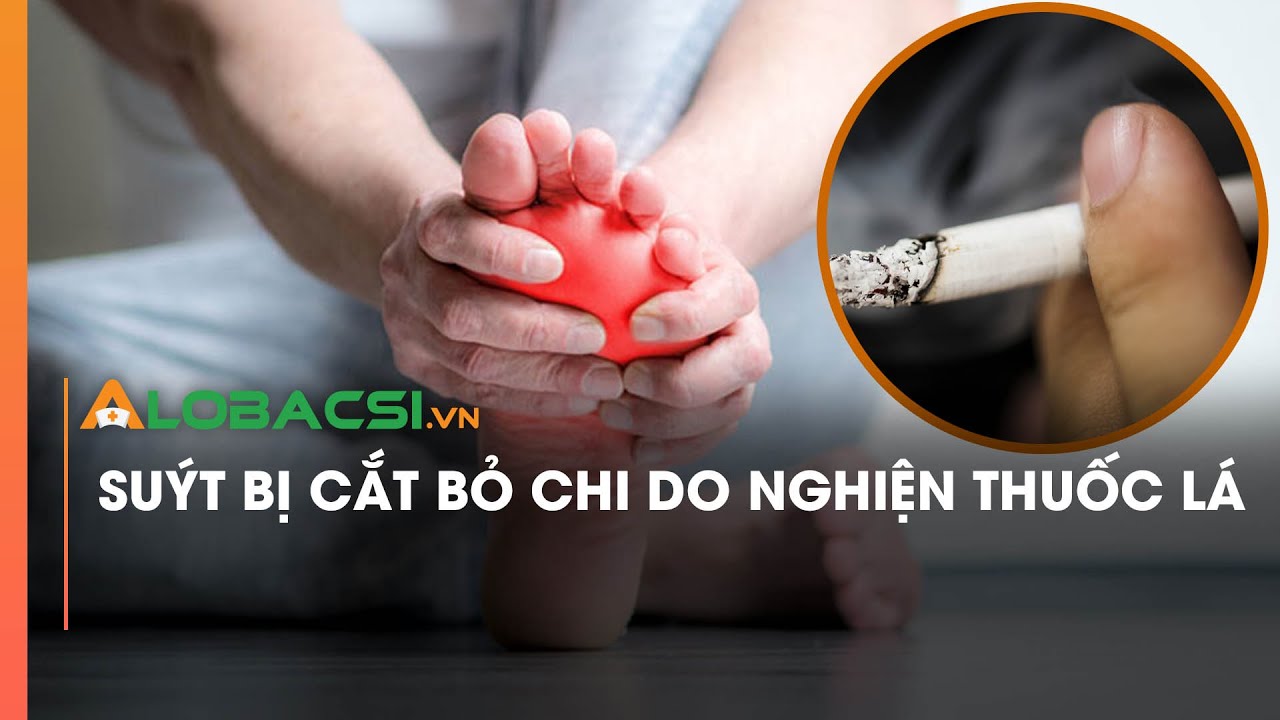 Suýt bị cắt bỏ chi do nghiện thuốc lá