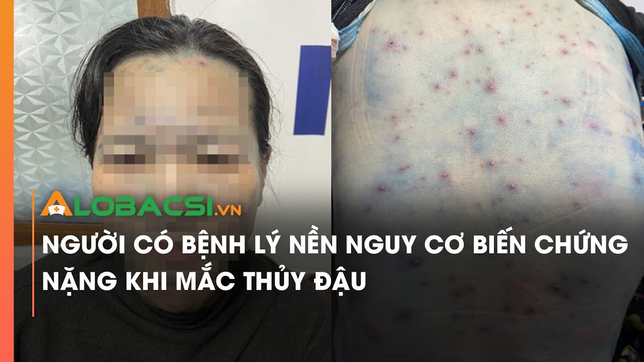 Người có bệnh lý nền nguy cơ biến chứng nặng khi mắc thủy đậu