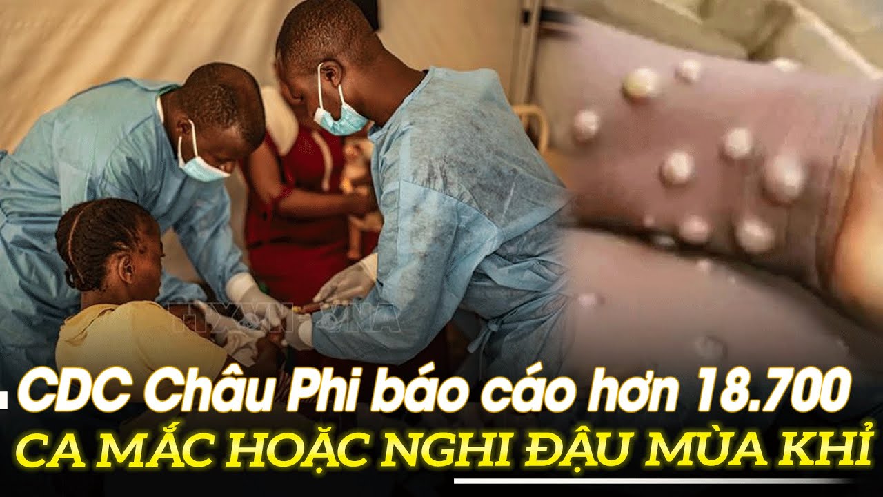 CDC Châu Phi báo cáo hơn 18.700 ca mắc hoặc nghi mắc đậu mùa khỉ | VOVTV