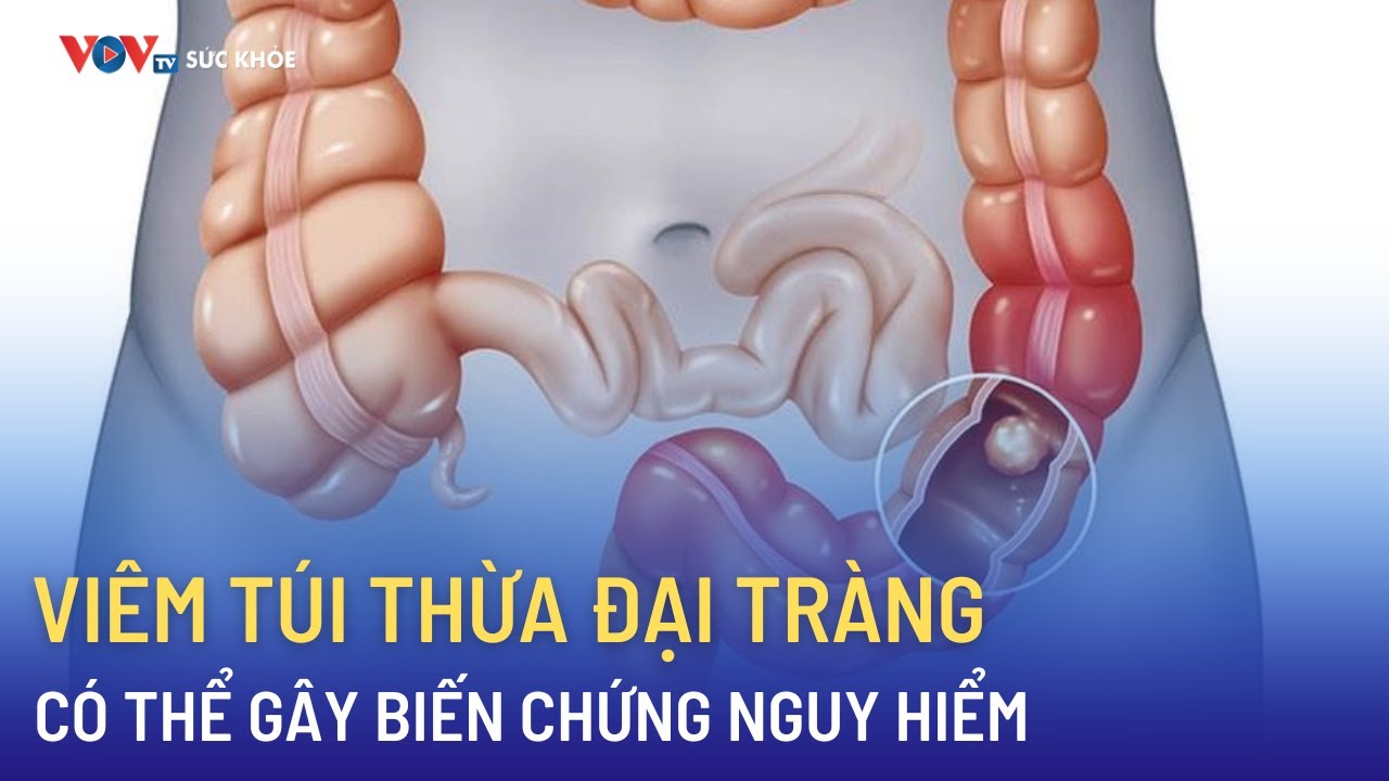 Viêm túi thừa đại tràng có thể gây biến chứng nguy hiểm | Bản tin Sức khỏe 24h