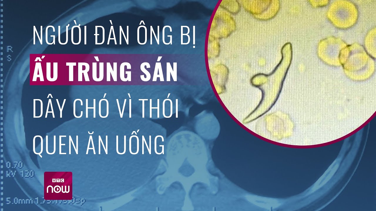 Phổi có cả ổ ấu trùng sán dây chó vì thói quen ăn uống quen thuộc | Tin nóng trong ngày| VTC Now