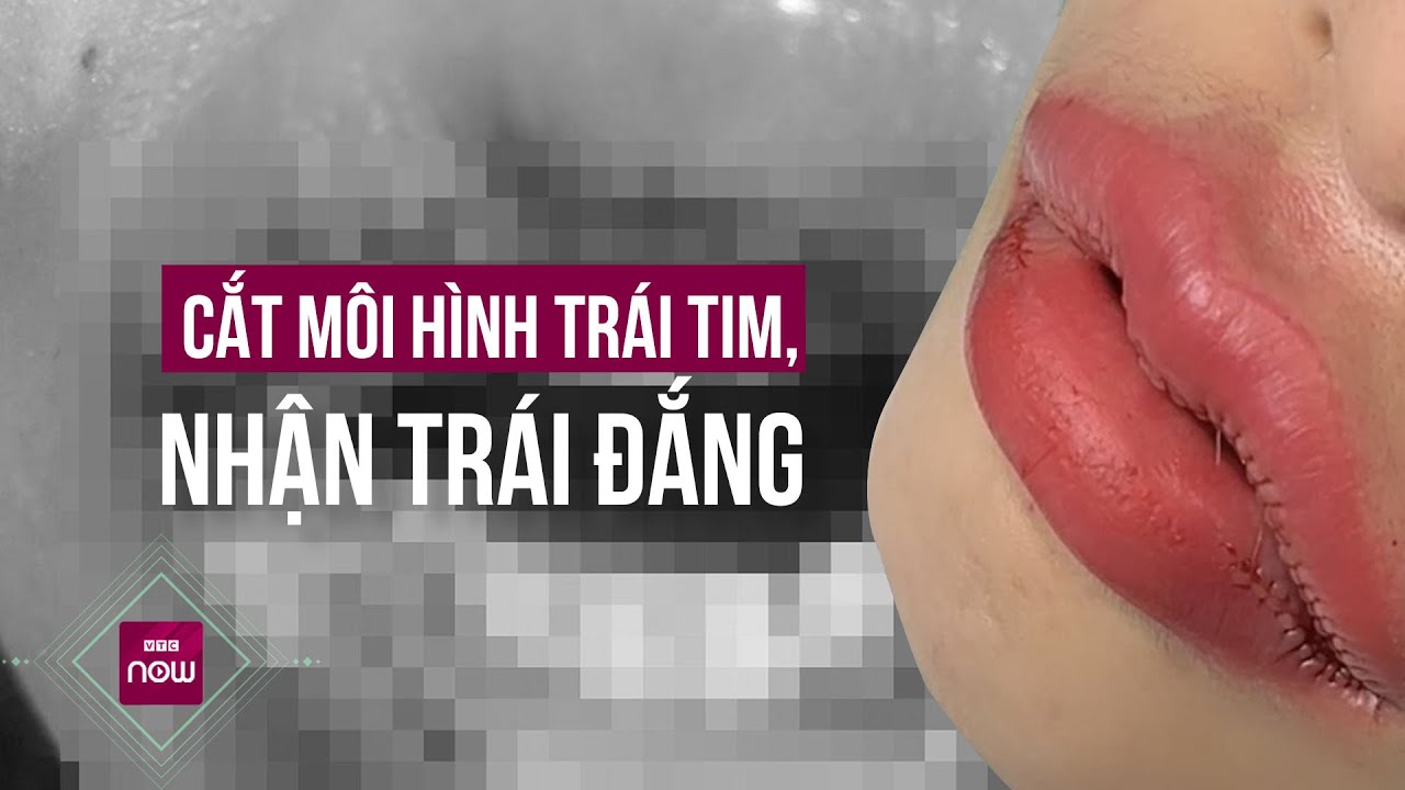 3 ngày sau khi cắt môi hình trái tim, cô gái bị nhiễm trùng biến dạng mặt | VTC Now