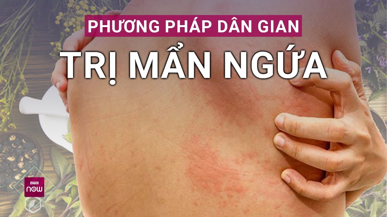 Những liệu pháp dân gian trị mẩn ngứa này vừa hiệu quả, vừa an toàn, không kém tân dược | VTC Now