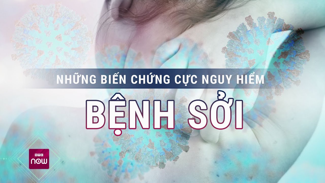 Những biến chứng cực nguy hiểm của bệnh sởi | VTC Now