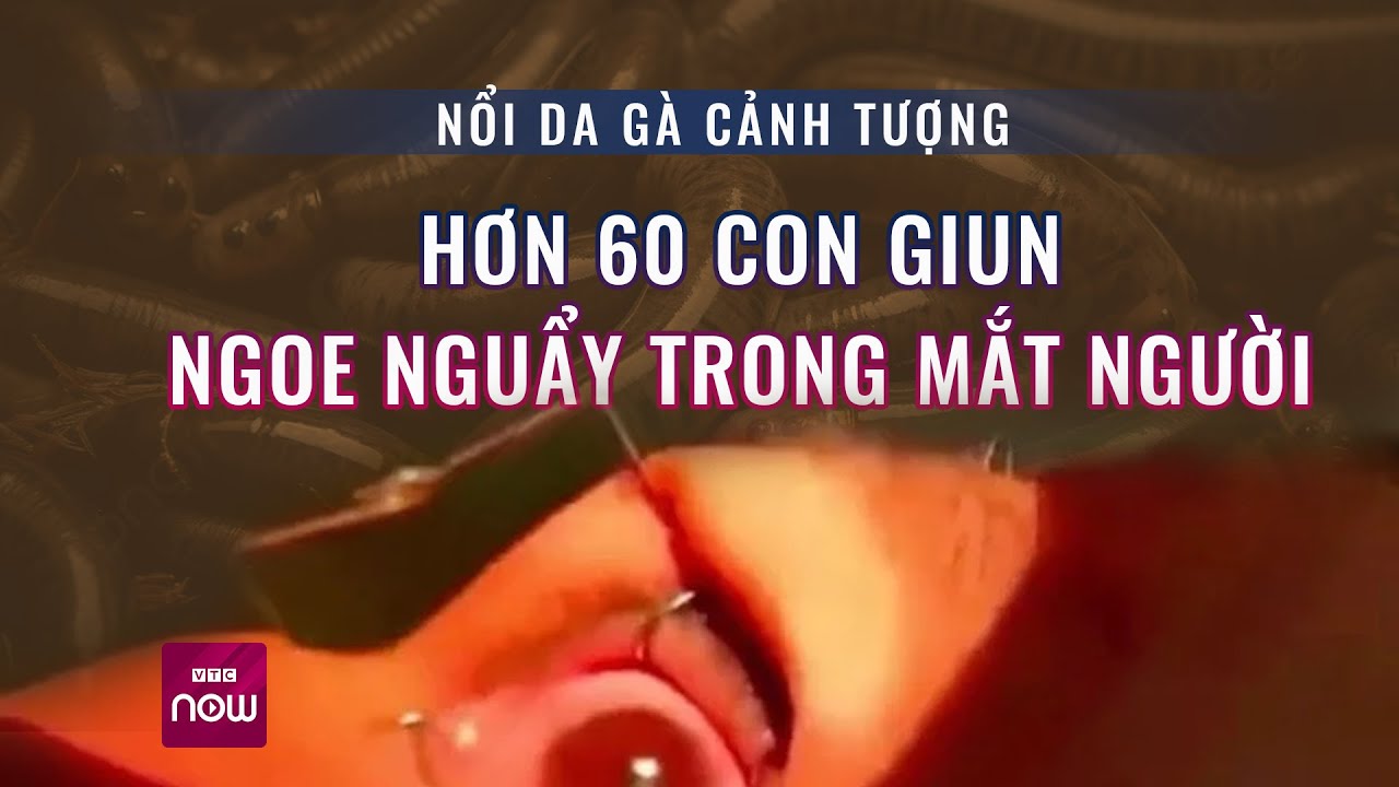 Nổi da gà cảnh tượng hơn 60 con giun bò lổm ngổm trong mắt người | VTC Now