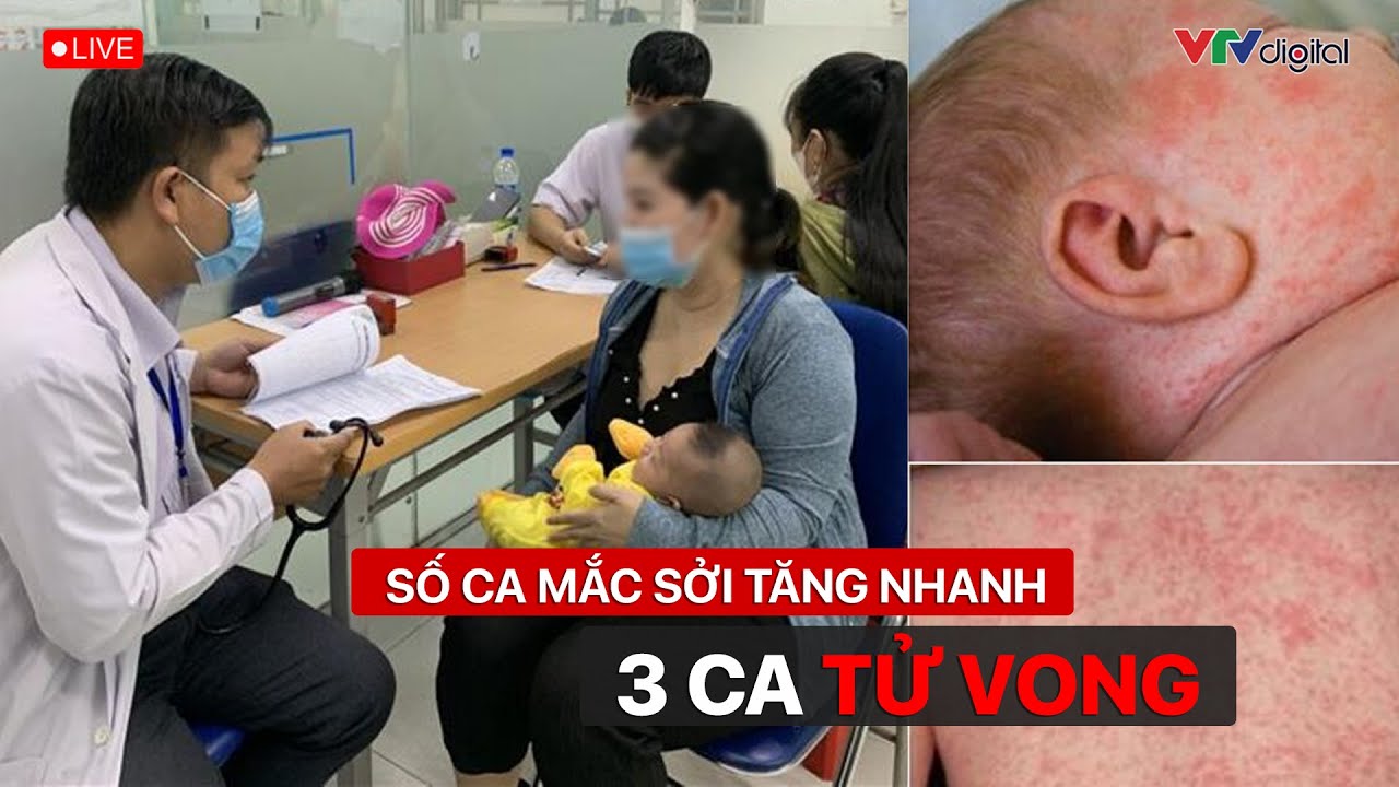 TP. Hồ Chí Minh: Số ca mắc sởi tăng nhanh, 3 ca tử vong | VTV24