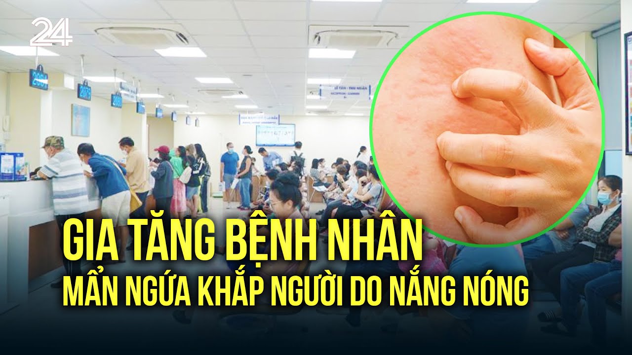 Gia tăng bệnh nhân mẩn ngứa khắp người do nắng nóng | VTV24