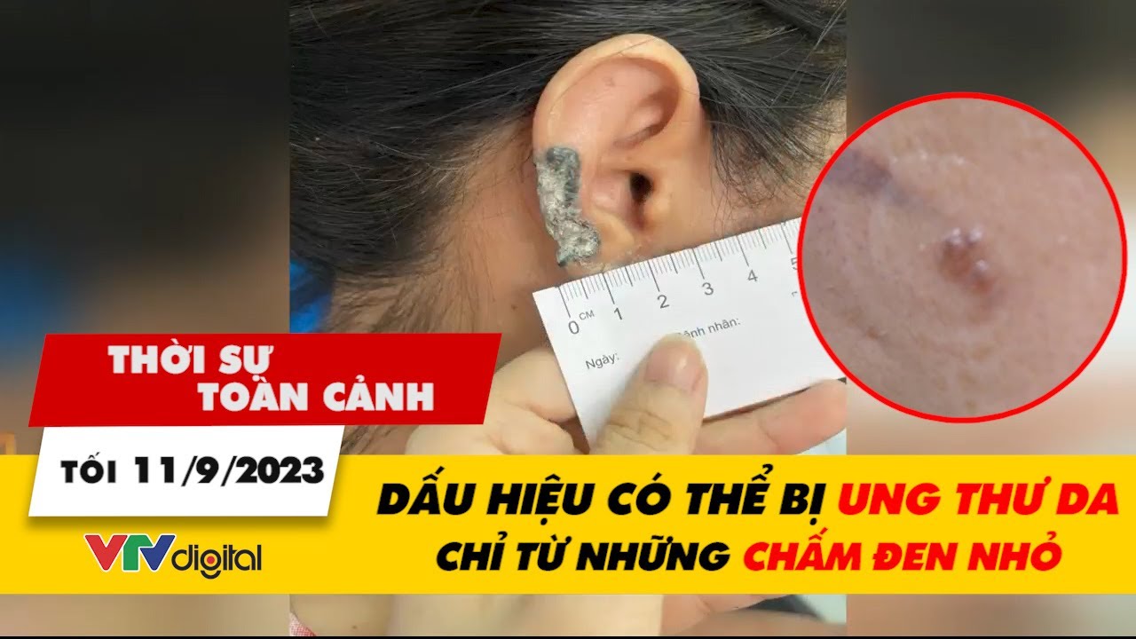 Thời sự toàn cảnh tối 11/9: Dấu hiệu có thể bị ung thư da chỉ từ những chấm đen nhỏ | VTV24