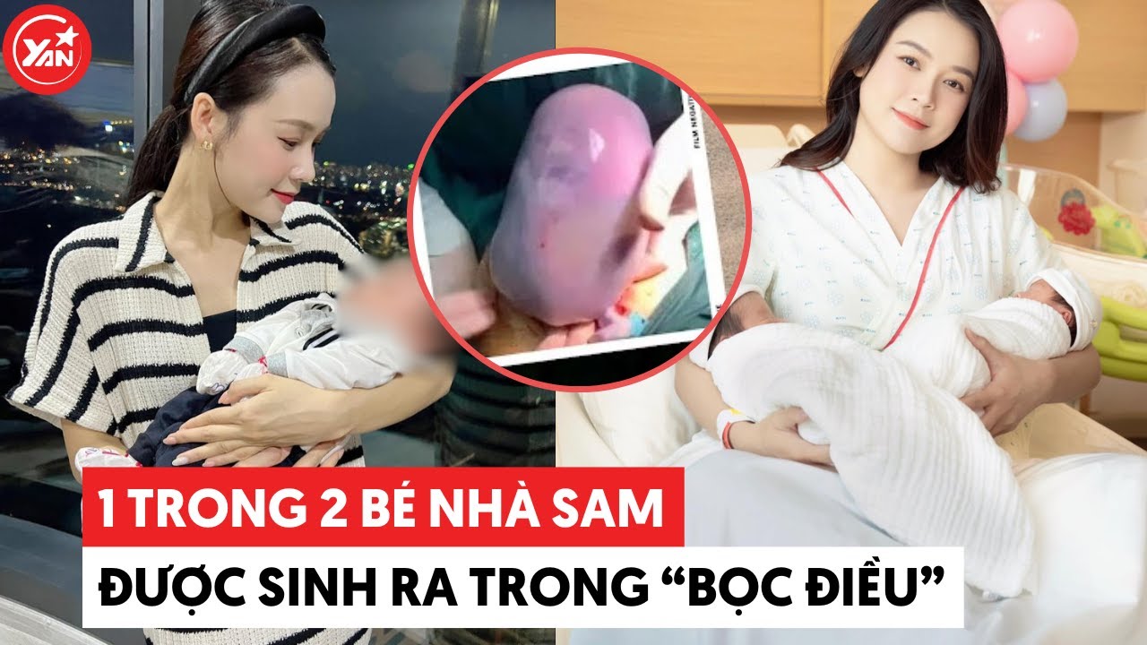 Sam sinh đôi, trong đó một em bé chào đời trong "bọc điều"