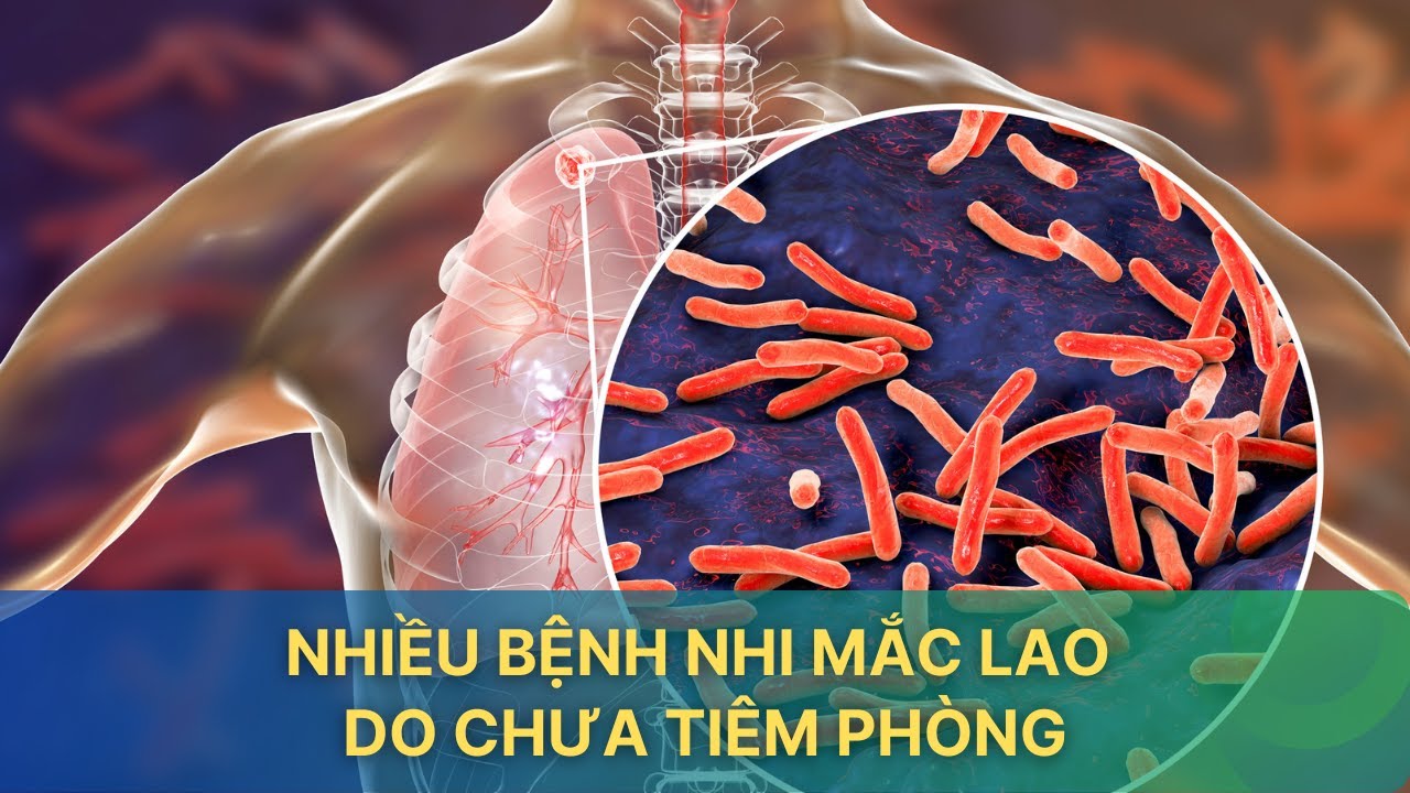 Nhiều bệnh nhi mắc lao do chưa tiêm phòng| VTV Sức khỏe