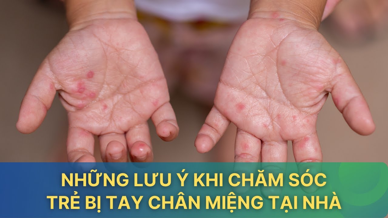 Những lưu ý khi chăm sóc trẻ mắc tay chân miệng tại nhà| VTV Sức khỏe