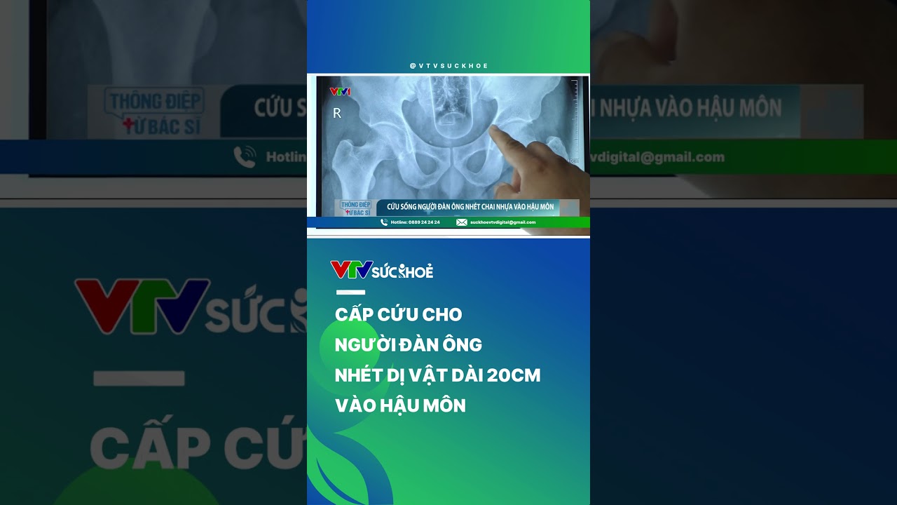 Cấp cứu người đàn ông nhét dị vật dài 20cm vào hậu môn| VTV Sức khỏe #shorts #vtvdigital #vtvsuckhoe