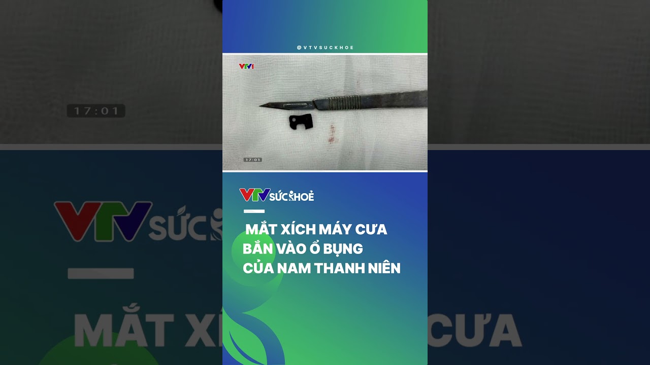 Nam thanh niên bị mắt xích máy cưa bắn vào ổ bụng | VTV Sức khỏe #shorts