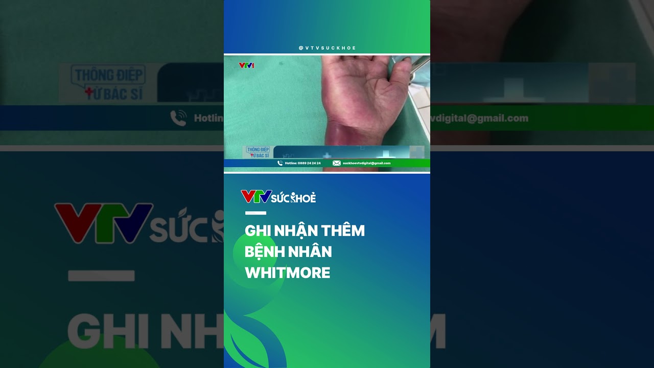 Ghi nhận thêm bệnh nhân whitmore | VTV Sức khỏe #shorts #new #tintuc #whitmore #dichbenh #laynhiem