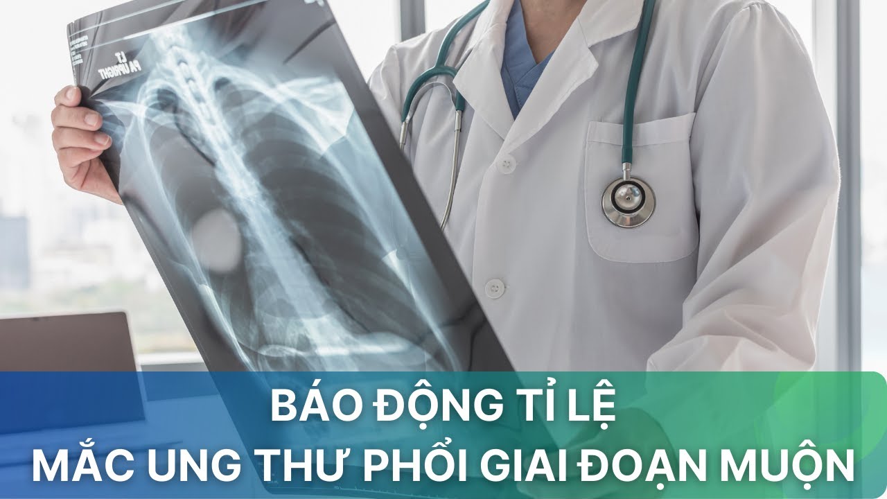 Báo động tỉ lệ mắc ung thư phổi giai đoạn muộn| VTV Sức khỏe