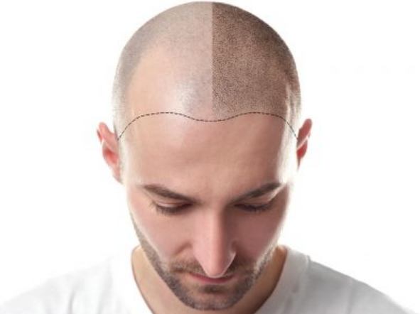 Erkeklerde Sac Dokulmesine Ne Iyi Gelir
