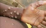 ｢猴痘｣在全球已有逾100例確診 WHO緊急開會防止武漢肺炎悲劇重演