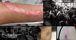 《明報》攝記手臂遭盾牌𠝹傷大面積脫皮　八傳媒工會要求 5.10 襲擊記者警員停職受查