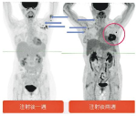 針後3周PET掃描 乳癌八成機率「假陽性」