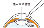 知多啲：屈光度數高、角膜薄 可植入式矯視手術