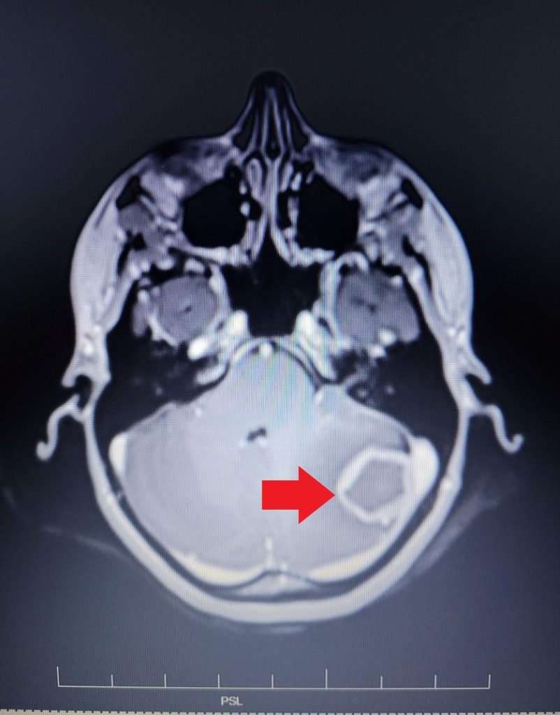 Medical scan image of Erin's tumor