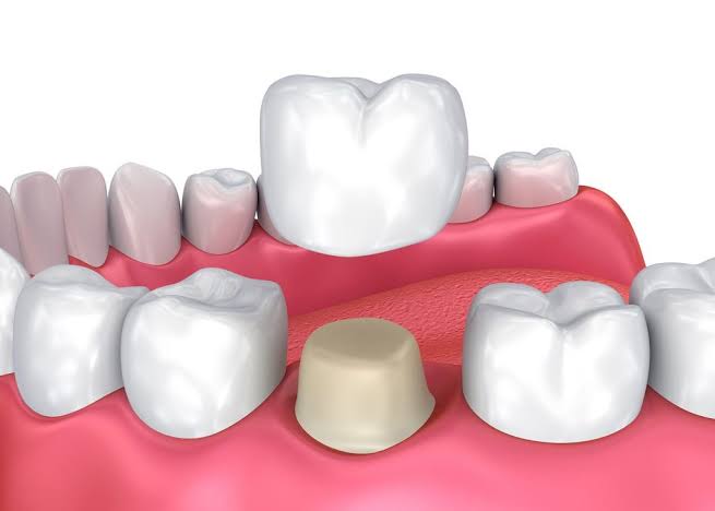 Dental Crowns