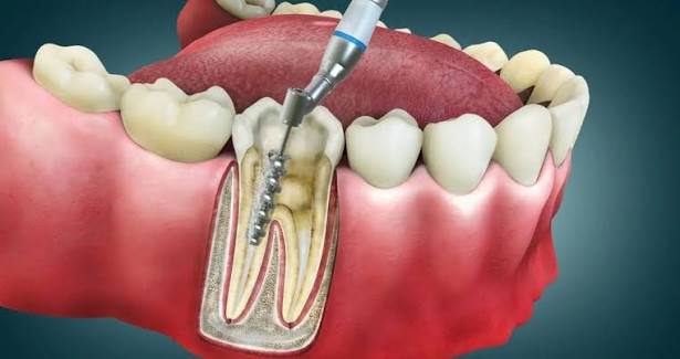 Root Canal Therapy
