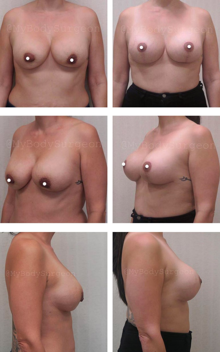 lipo and breast lift houston texas